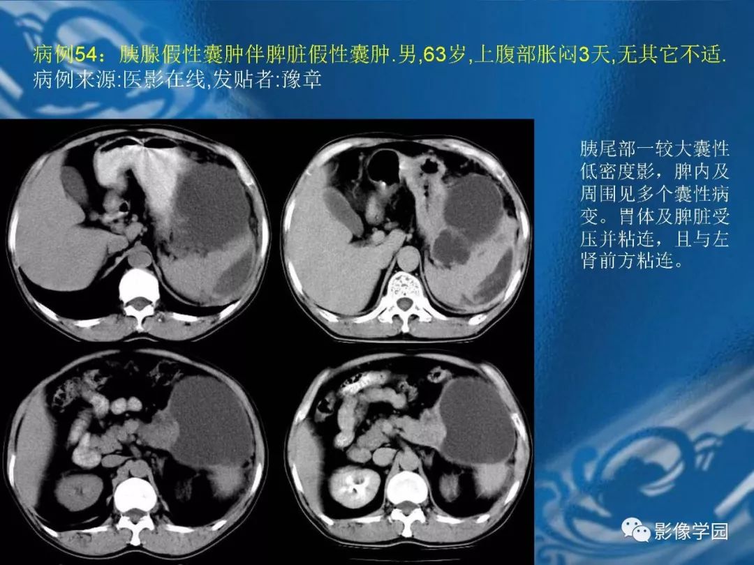 【PPT】脾脏病变大汇集