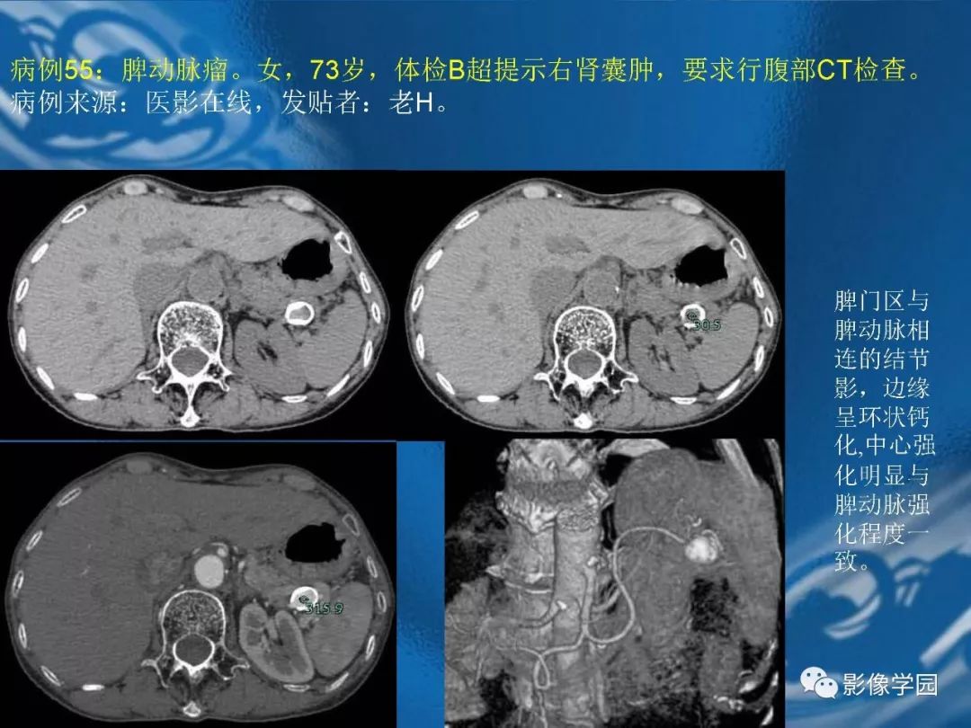 【PPT】脾脏病变大汇集