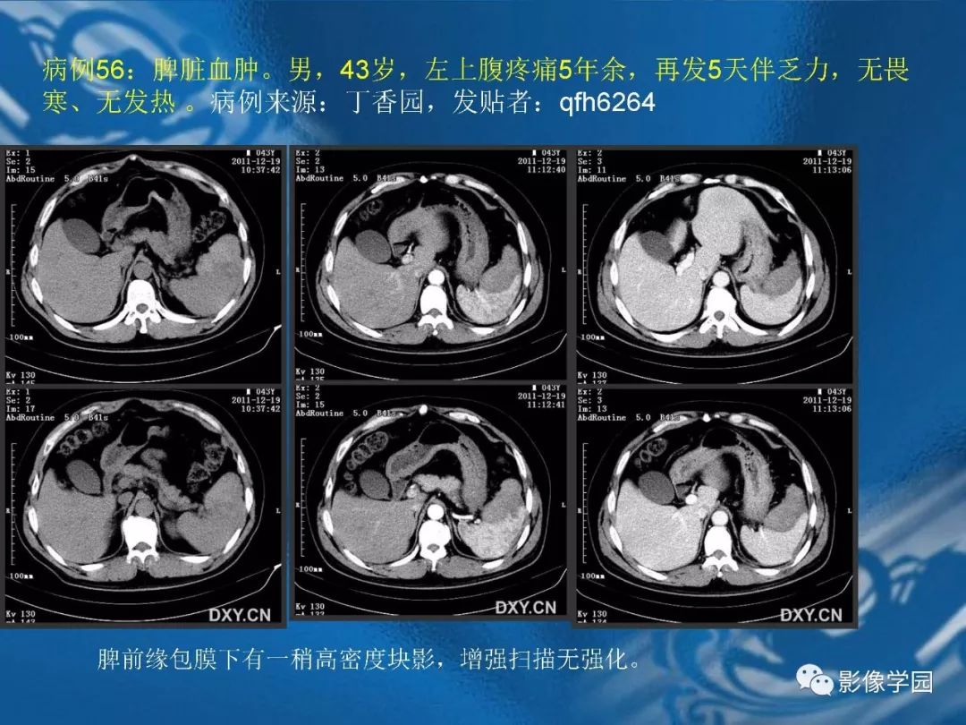 【PPT】脾脏病变大汇集