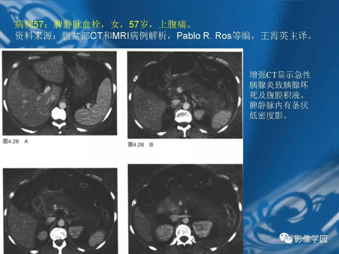 【PPT】脾脏病变大汇集
