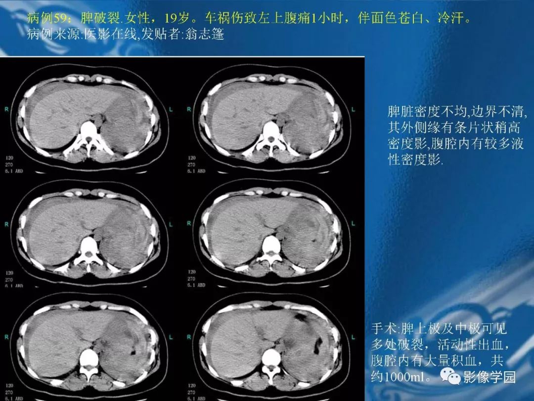 【PPT】脾脏病变大汇集