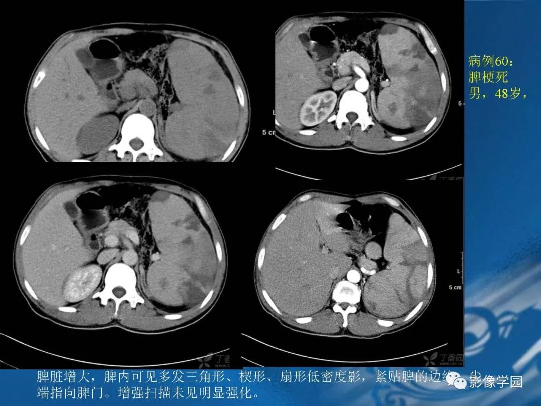 【PPT】脾脏病变大汇集
