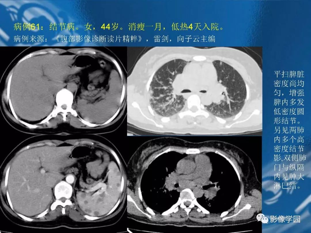 【PPT】脾脏病变大汇集