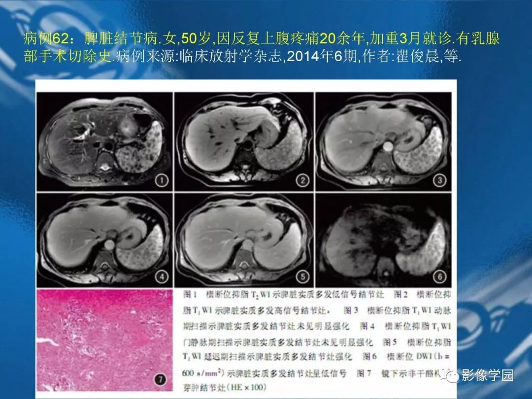 【PPT】脾脏病变大汇集