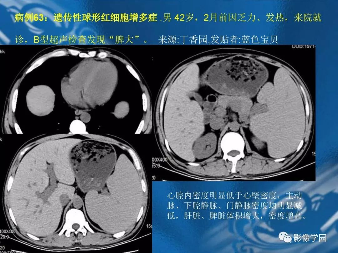 【PPT】脾脏病变大汇集