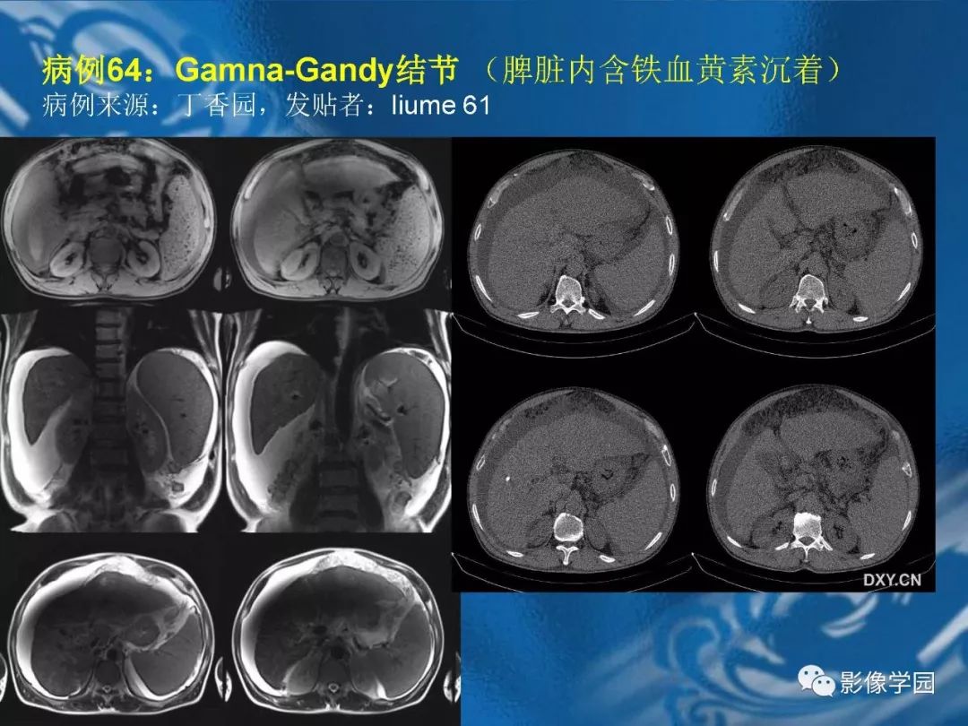【PPT】脾脏病变大汇集