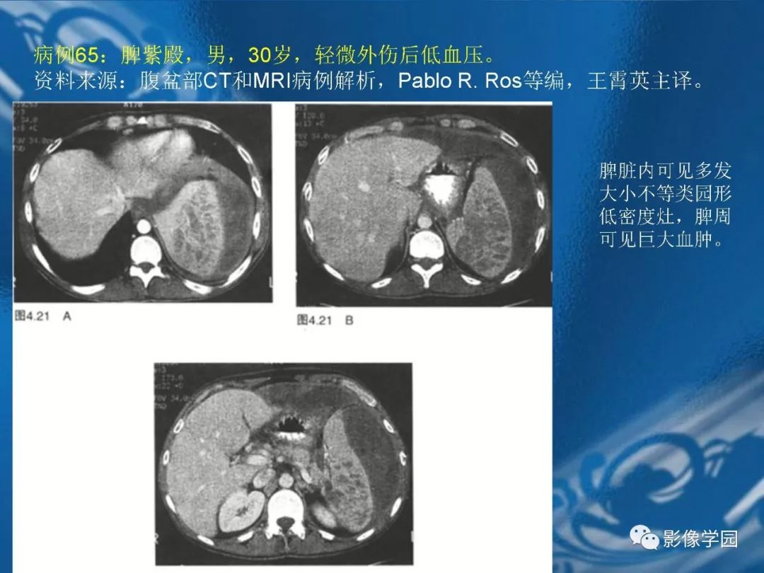 【PPT】脾脏病变大汇集