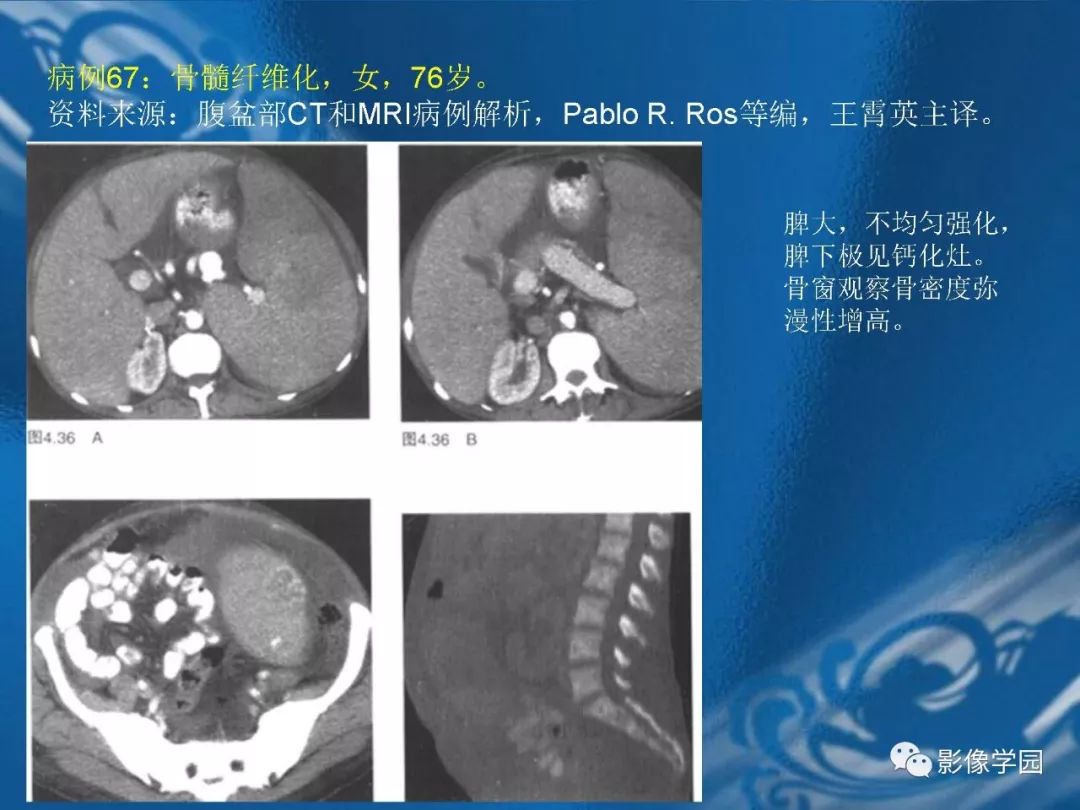 【PPT】脾脏病变大汇集