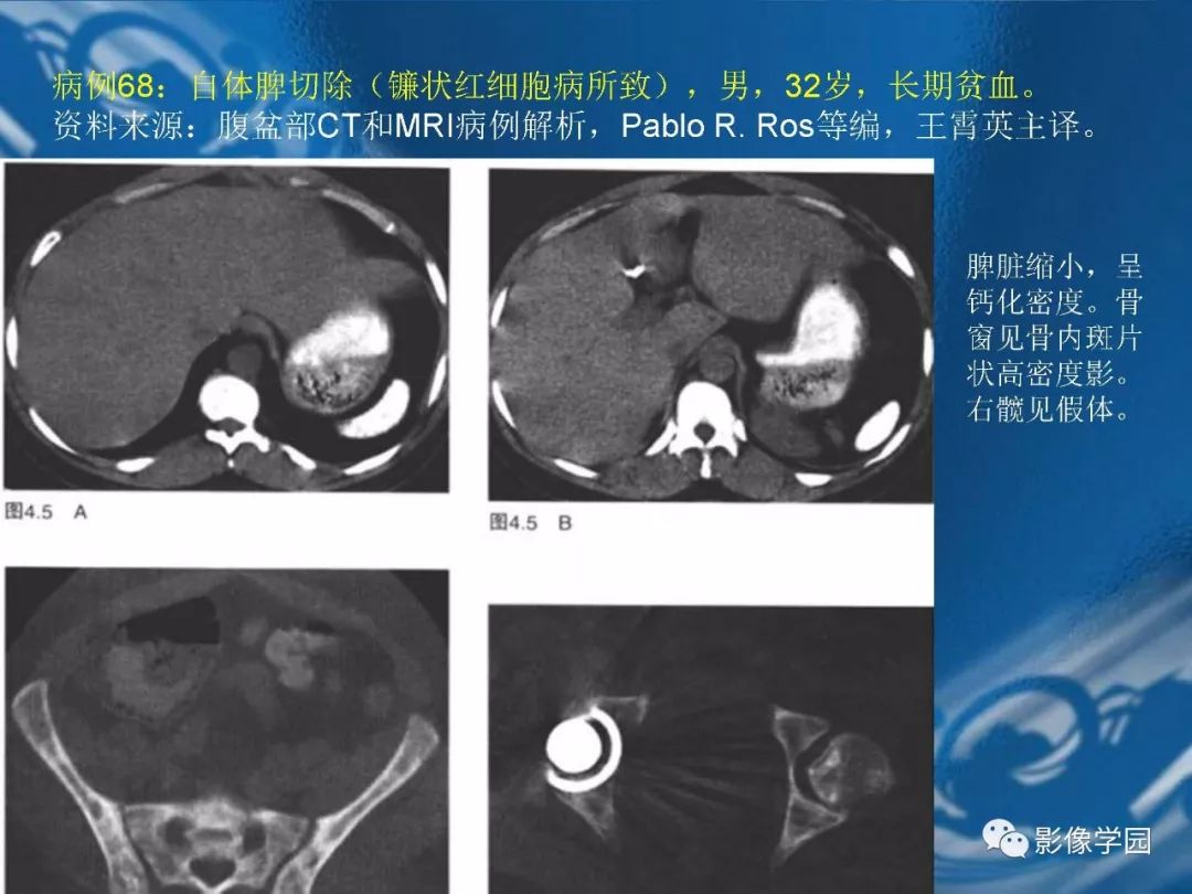 【PPT】脾脏病变大汇集