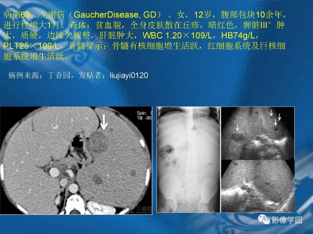 【PPT】脾脏病变大汇集