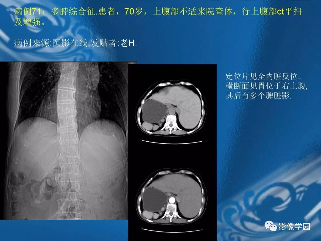 【PPT】脾脏病变大汇集