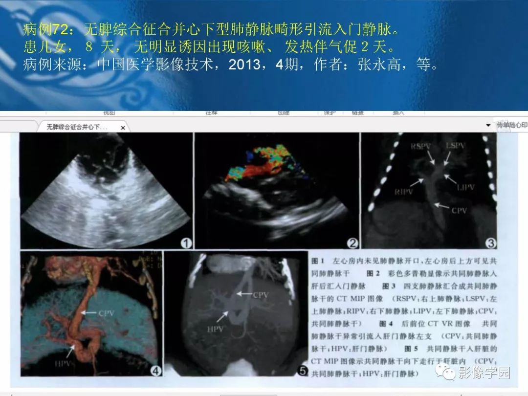 【PPT】脾脏病变大汇集