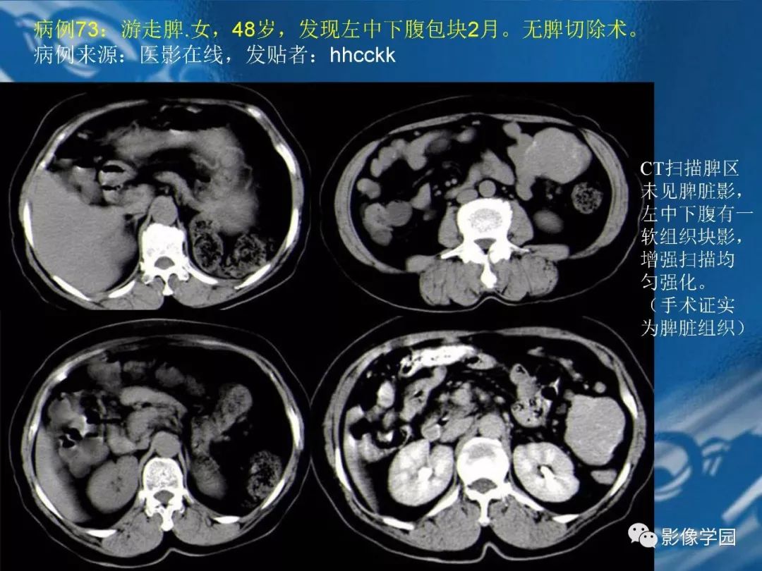 【PPT】脾脏病变大汇集