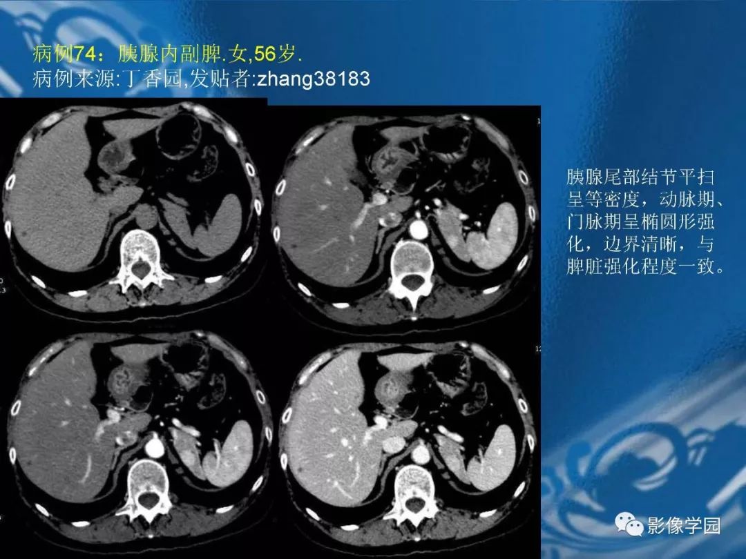 【PPT】脾脏病变大汇集
