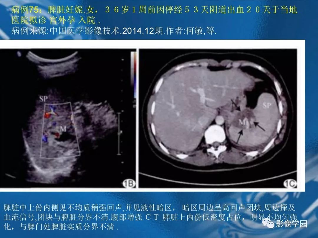 【PPT】脾脏病变大汇集