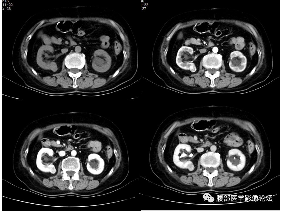 【病例】右肾透明细胞肾癌1例CT