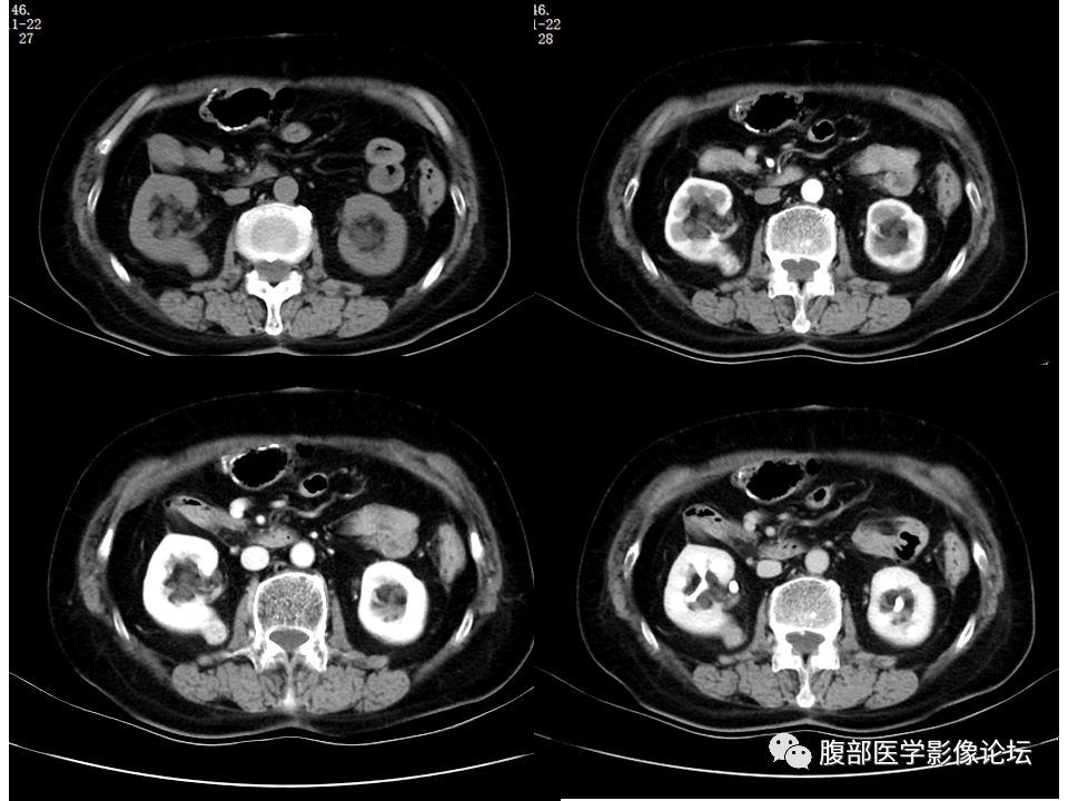 【病例】右肾透明细胞肾癌1例CT