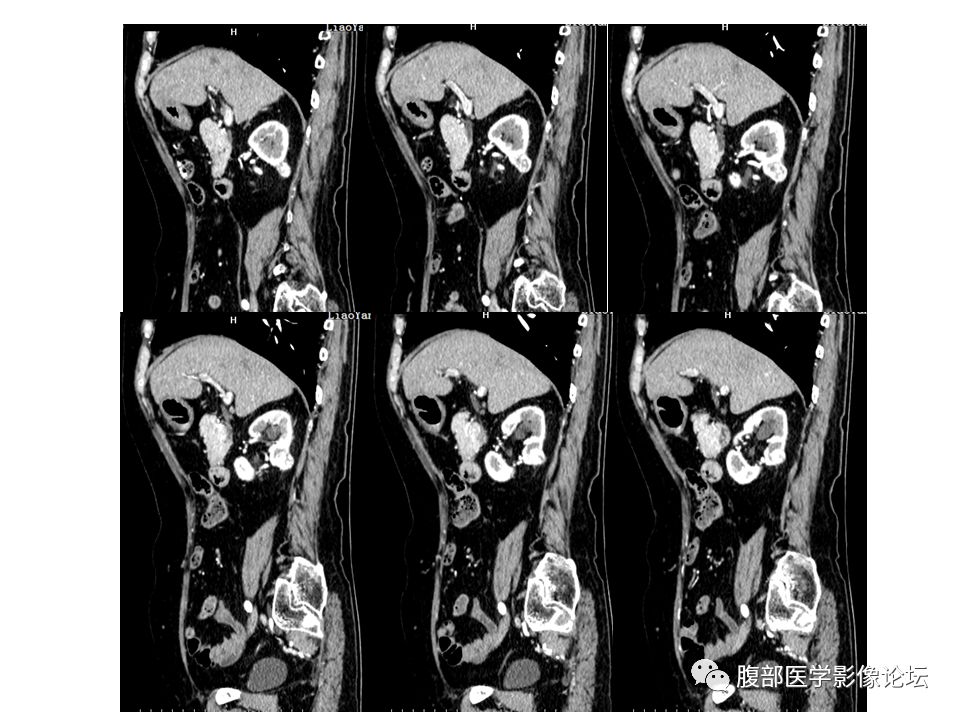 【病例】右肾透明细胞肾癌1例CT