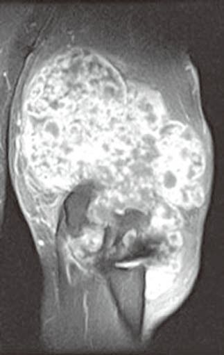 滑膜软骨瘤病(滑膜骨软骨瘤病) 滑膜软骨瘤病(滑膜骨软骨瘤病)