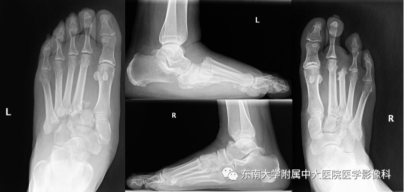 【病例】夏科氏关节病1例X线CT及MR影像诊断