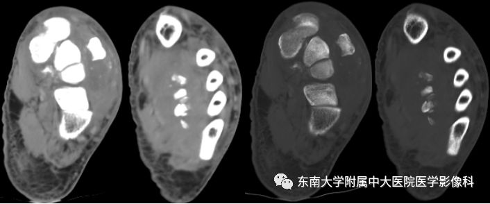 【病例】夏科氏关节病1例X线CT及MR影像诊断