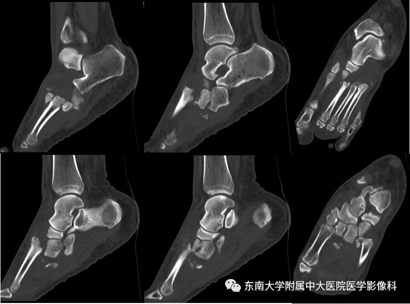 【病例】夏科氏关节病1例X线CT及MR影像诊断