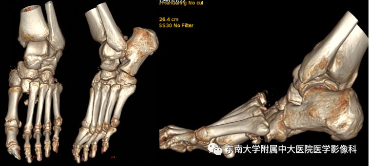 【病例】夏科氏关节病1例X线CT及MR影像诊断