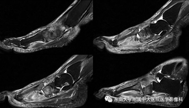 【病例】夏科氏关节病1例X线CT及MR影像诊断