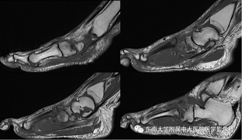 【病例】夏科氏关节病1例X线CT及MR影像诊断