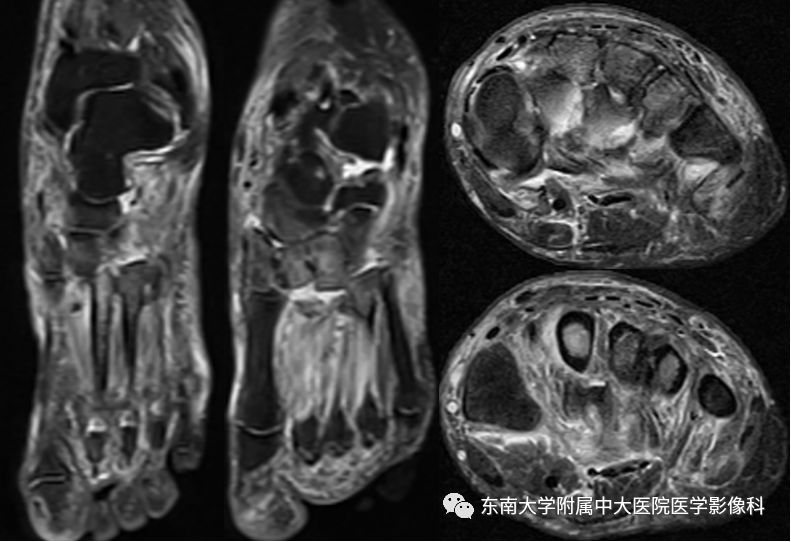 【病例】夏科氏关节病1例X线CT及MR影像诊断