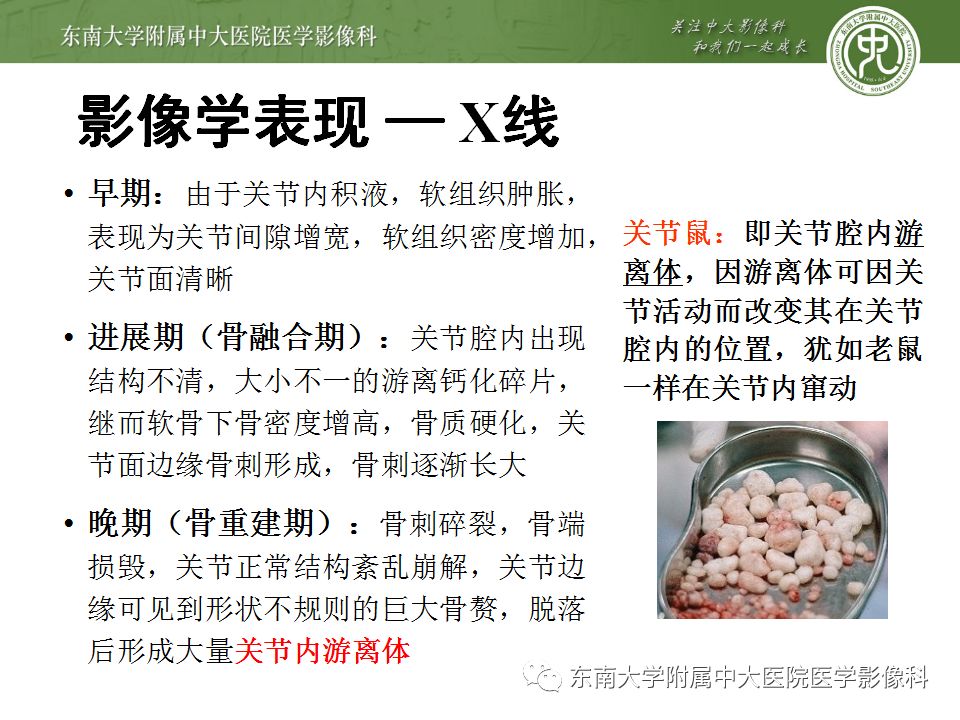 【病例】夏科氏关节病1例X线CT及MR影像诊断