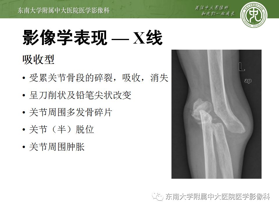 【病例】夏科氏关节病1例X线CT及MR影像诊断