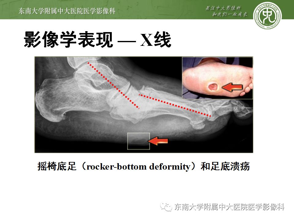 【病例】夏科氏关节病1例X线CT及MR影像诊断