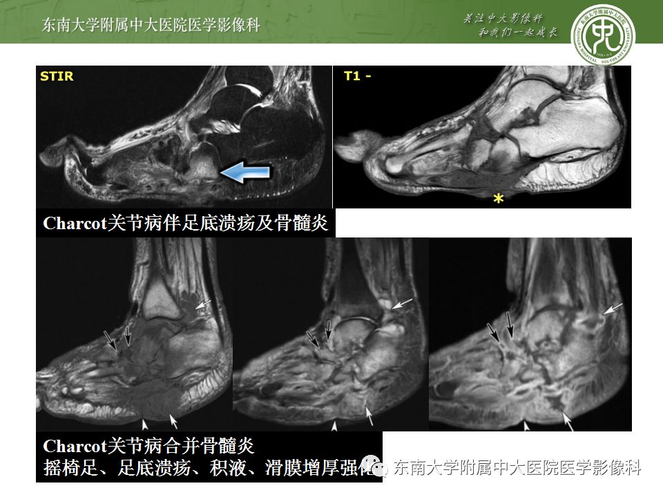 【病例】夏科氏关节病1例X线CT及MR影像诊断