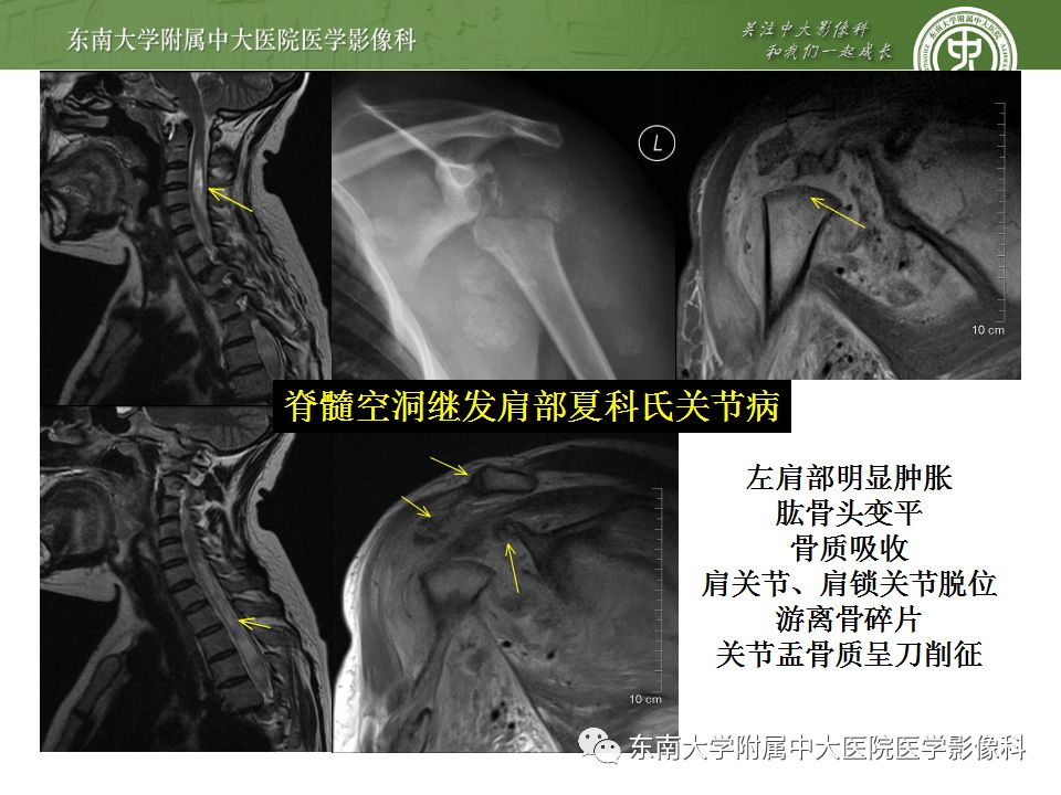【病例】夏科氏关节病1例X线CT及MR影像诊断