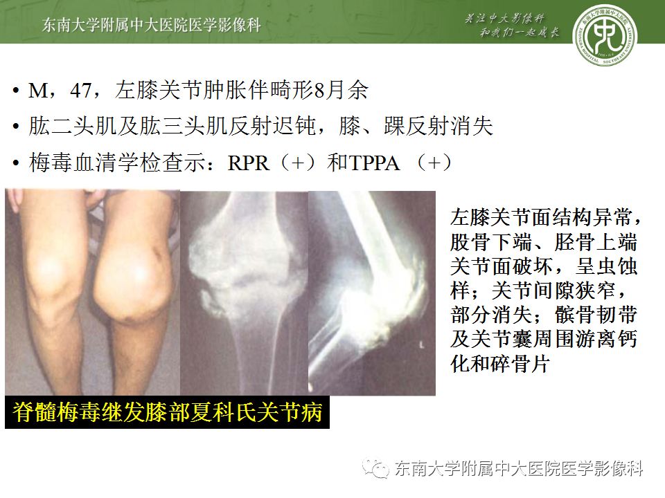【病例】夏科氏关节病1例X线CT及MR影像诊断