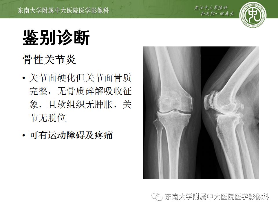 【病例】夏科氏关节病1例X线CT及MR影像诊断