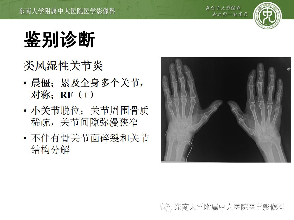 【病例】夏科氏关节病1例X线CT及MR影像诊断