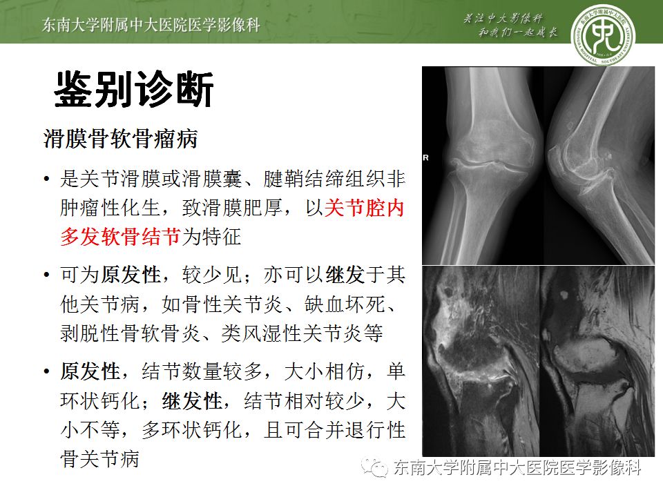 【病例】夏科氏关节病1例X线CT及MR影像诊断