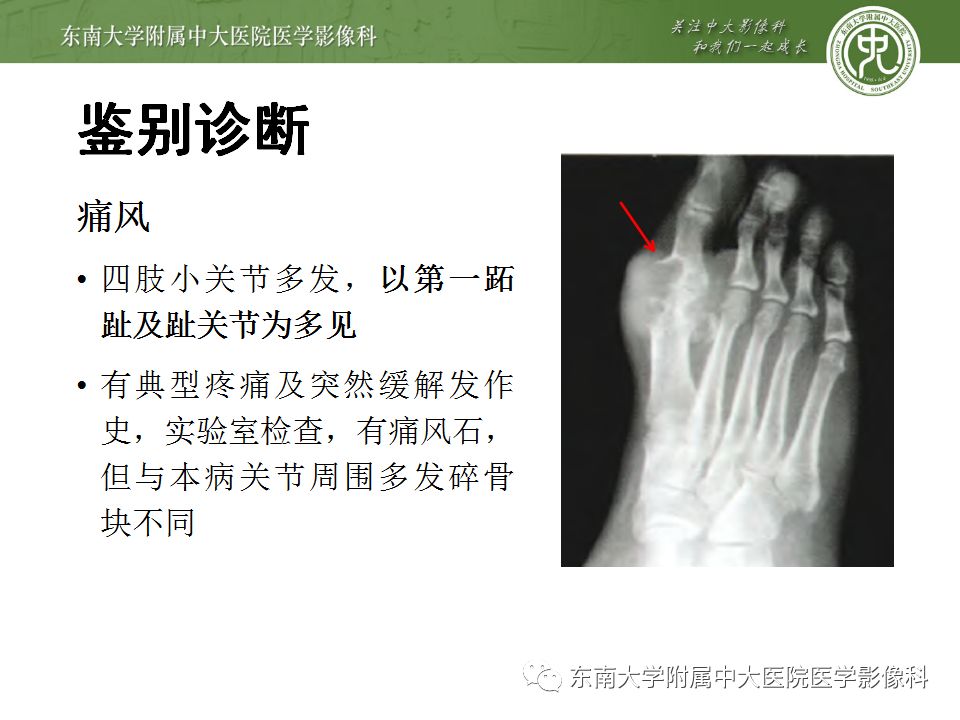 【病例】夏科氏关节病1例X线CT及MR影像诊断