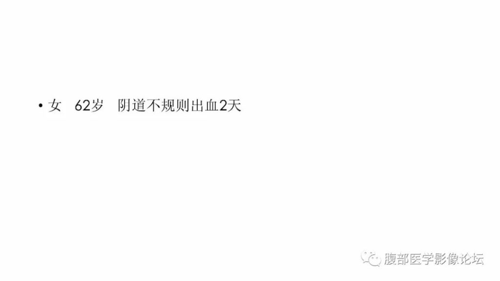 【病例】成人型颗粒细胞瘤1例CT