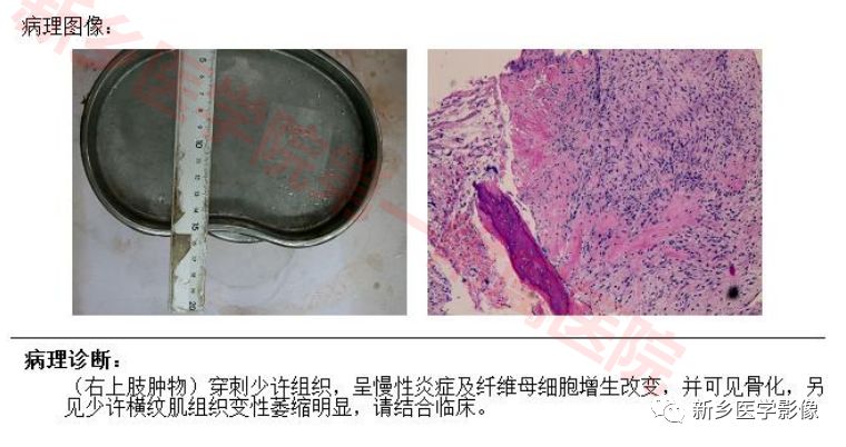 【病例】右侧上臂骨化性肌炎1例CT影像表现 【病例】右侧上臂骨化性肌炎1例CT影像表现
