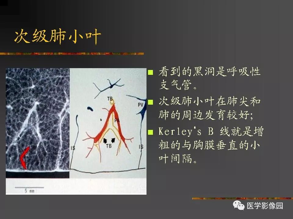 【PPT】间质性肺疾病及其影像诊断