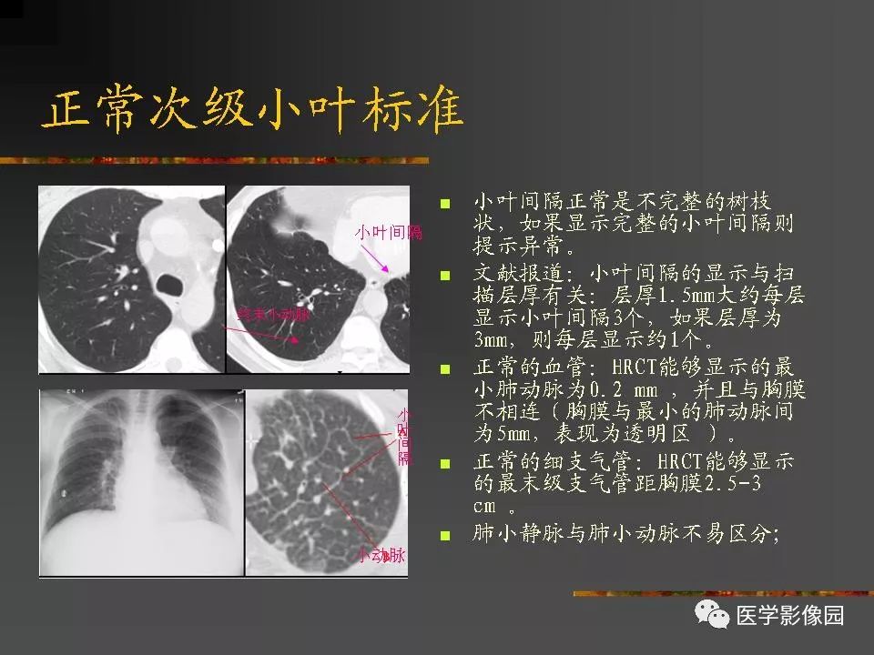 【PPT】间质性肺疾病及其影像诊断