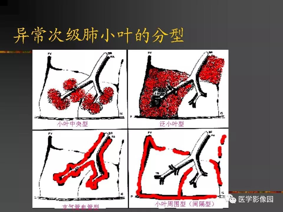 【PPT】间质性肺疾病及其影像诊断