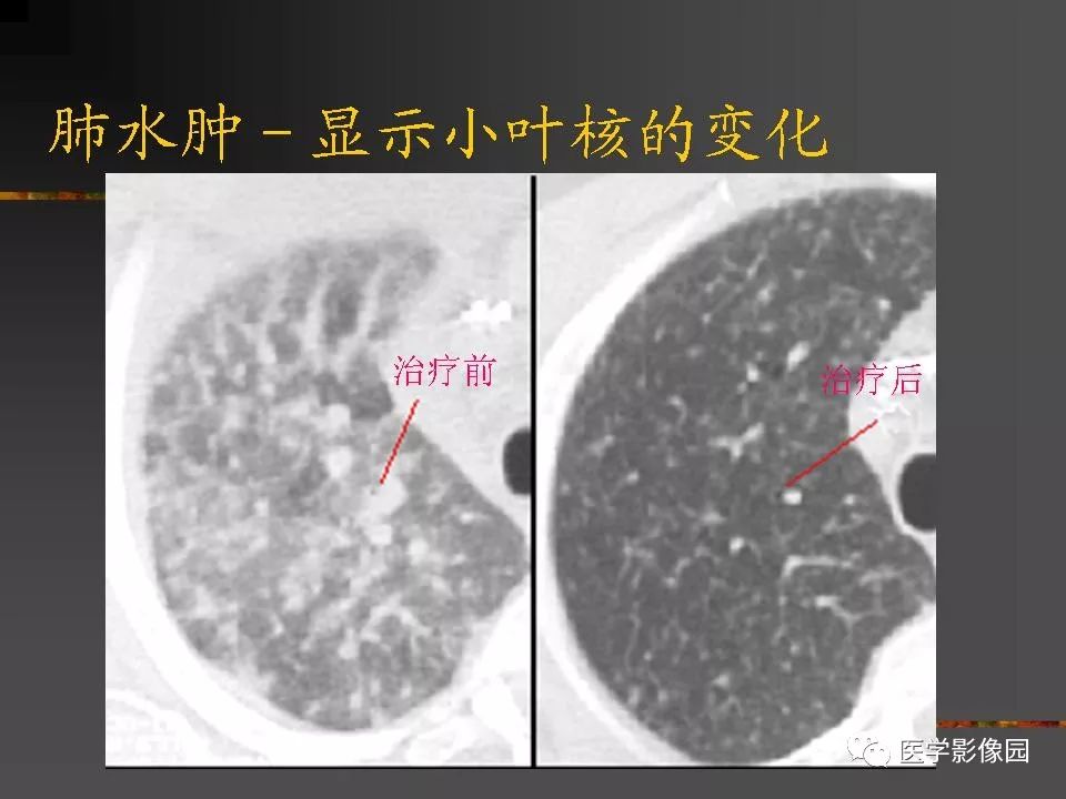 【PPT】间质性肺疾病及其影像诊断