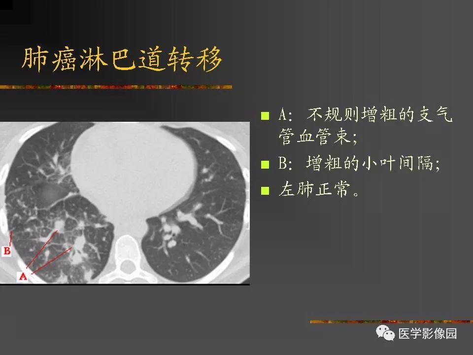 【PPT】间质性肺疾病及其影像诊断