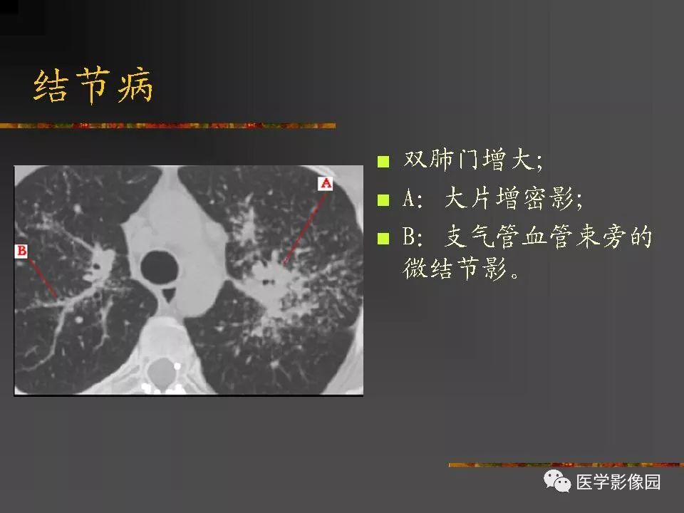 【PPT】间质性肺疾病及其影像诊断
