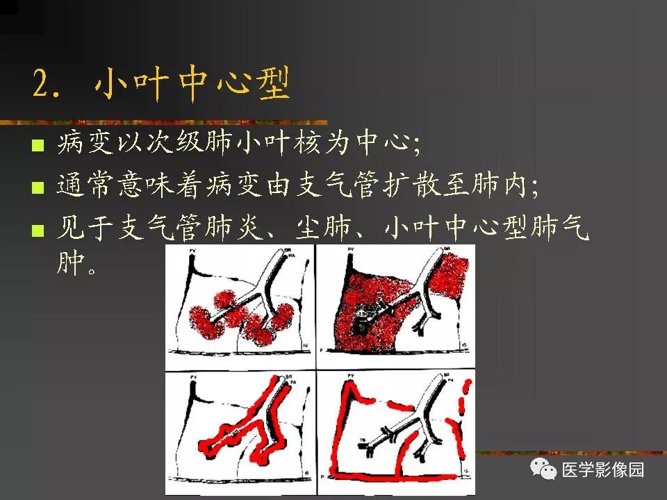 【PPT】间质性肺疾病及其影像诊断