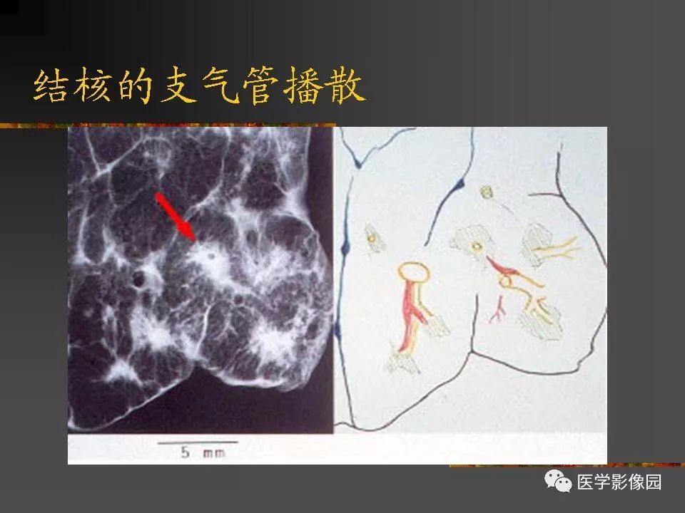 【PPT】间质性肺疾病及其影像诊断